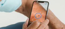 Skinvision: Dank AXA (DE) kostenlos via App Stellen auf Hautkrebs prüfen