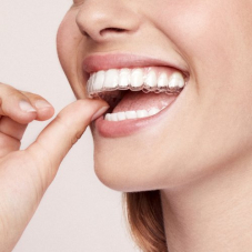 Bis zu CHF 1000.- Rabatt bei bestsmile